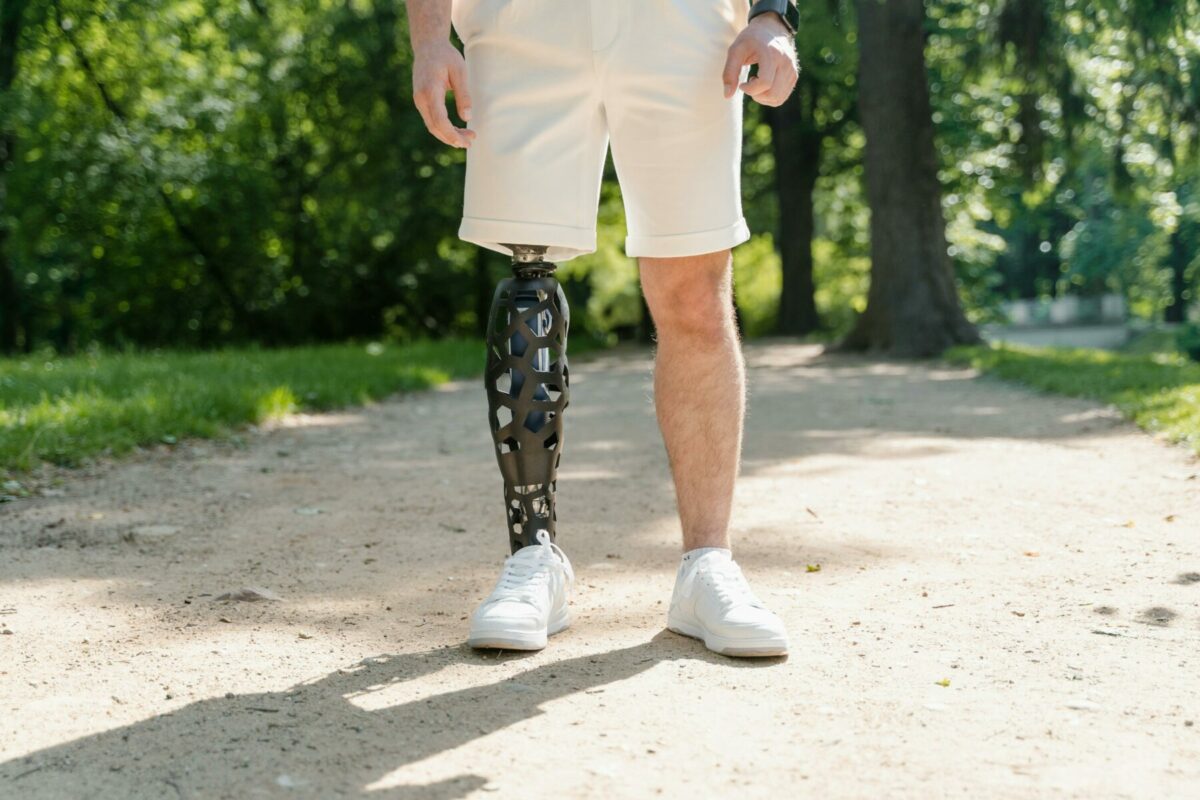 prothèse indemnisation cabinet nicolau avocats, amputation